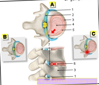 Figure: intervertebral disc bulge