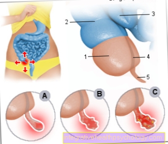Illustration appendicitis