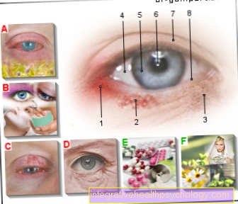 Figure eczema on the eye
