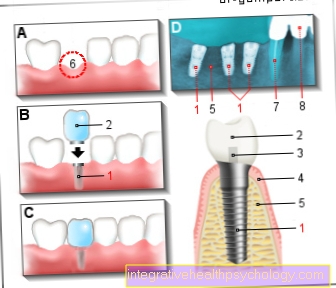 Illustration dental implant