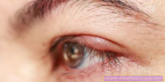 Eyelid inflammation
