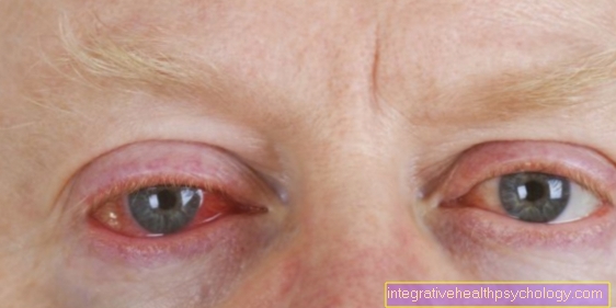 Chlamydial infection of the eye