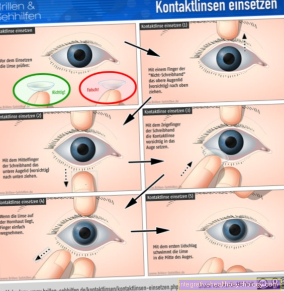 The insertion of contact lenses
