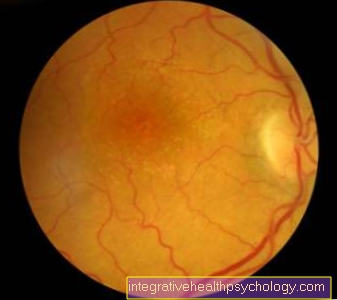 Circulatory disorder of the retina
