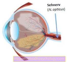 Inflammation of the optic nerve