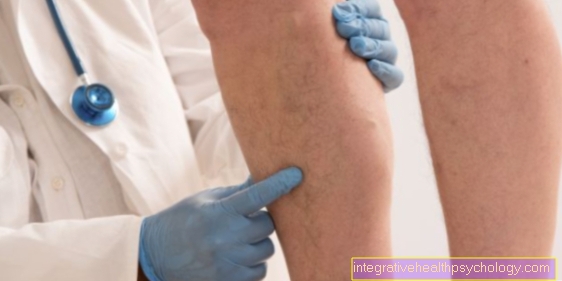 Compartment syndrome on the lower leg