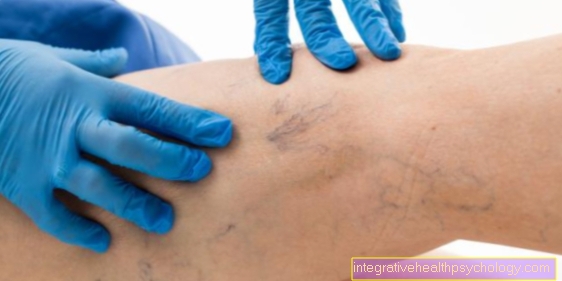 This is how varicose veins are removed