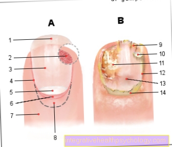 Treatment of the nail fungus