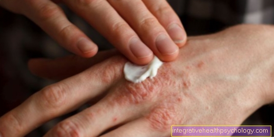 Treatment of atopic dermatitis
