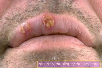 Symptoms of herpes