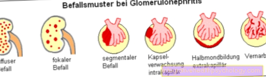 Forms glomerulonephritis