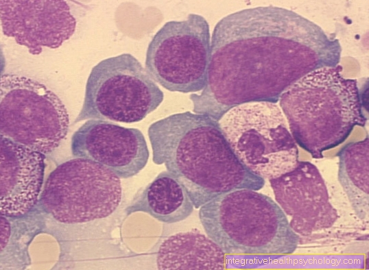 Megaloblastic anemia