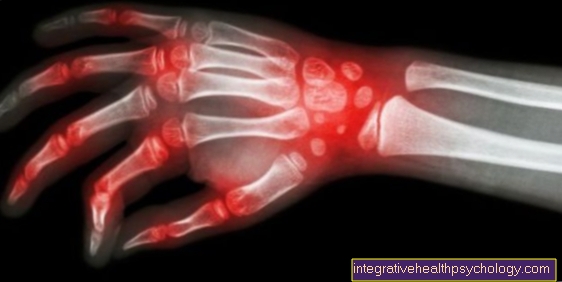 Causes of Rheumatoid Arthritis