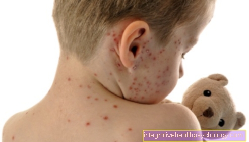 Therapy of chickenpox