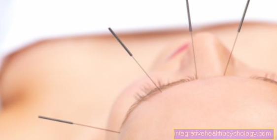Pain after acupuncture