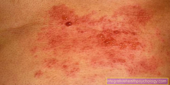 Shingles on the stomach