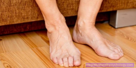 Big toe joint arthrosis