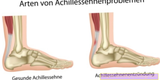 Home remedies for Achilles tendonitis