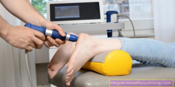 Shock wave therapy for a calcaneal spur