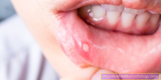 Duration of canker sores