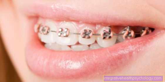 The cost of braces