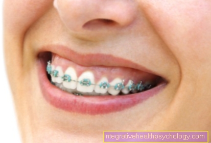 The braces rubbers