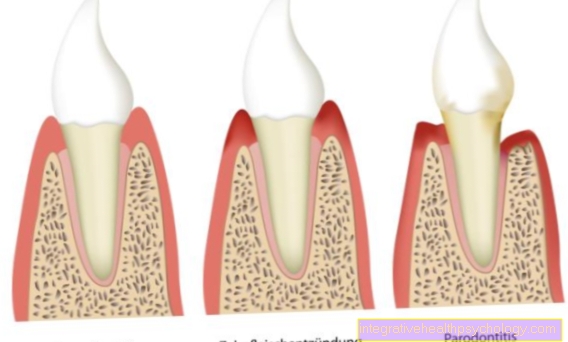 Periodontal disease and periodontal disease