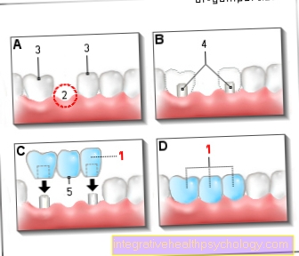 Dental bridge as a dental prosthesis