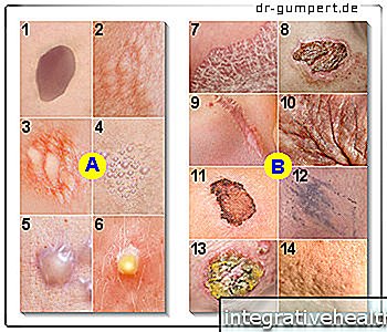 Illustration of skin lesions 
